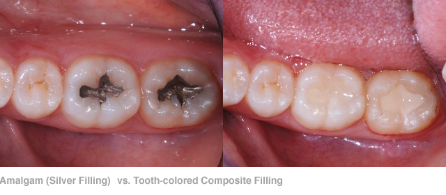 Tooth Colored Composite Fillings Olympic Dental Of Sugar Land