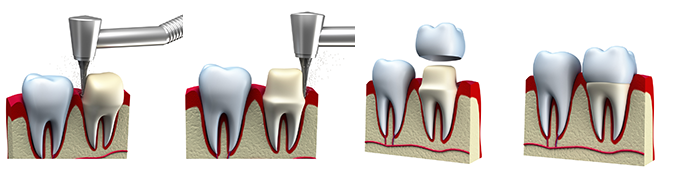 Dental_Crown_Olympic_Dental