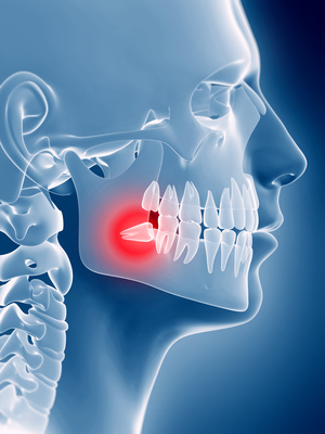 Olympic Dental of Sugar Land-Impacted Wisdom Teeth Impacted Wisdom Teeth