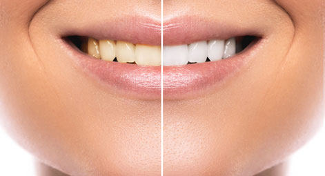 teeth-whitening-sugarland
