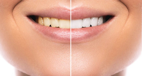 teeth-whitening-sugarland teeth-whitening-sugarland